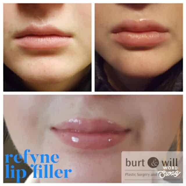Lip Augmentation IMG 0385 - Lip Augmentation